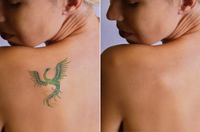 What You Need to Know About Tattoo Removal | HealthNews
