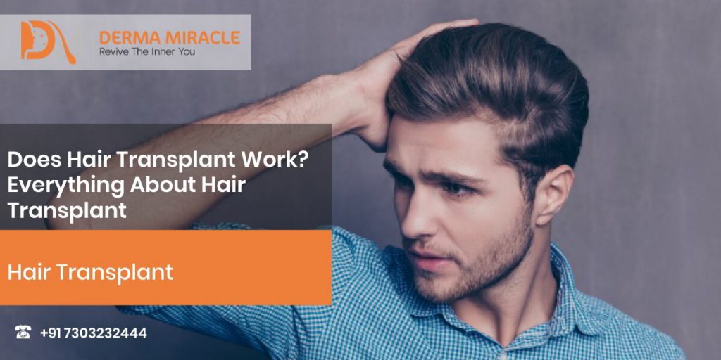 Does Hair Transplant Work? Everything About Hair Transplant – Derma Miracle