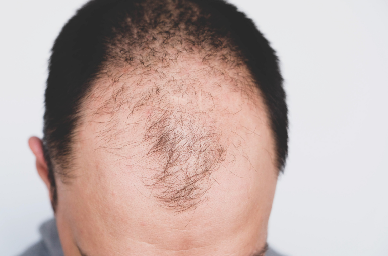 Excess Hair Loss Problem Doesn't Always Mean You're Balding (Here's Why) –  Derma Miracle