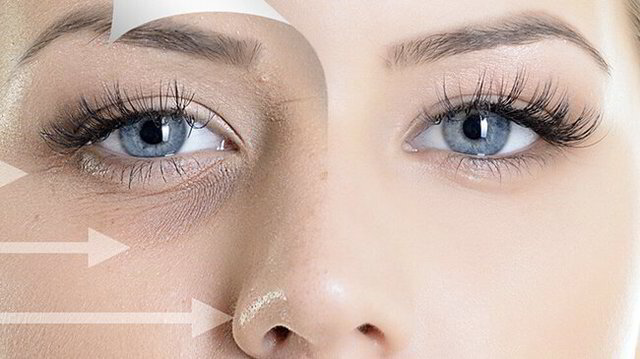 Filler for Dark Under Eye Circles  Get Rid of Undereye Circles With  Injections