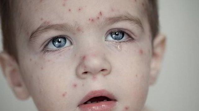 Chicken Pox Scar 4121349 