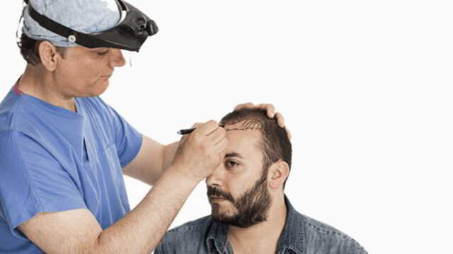 FUE Hair Transplant in Delhi- Giga Session