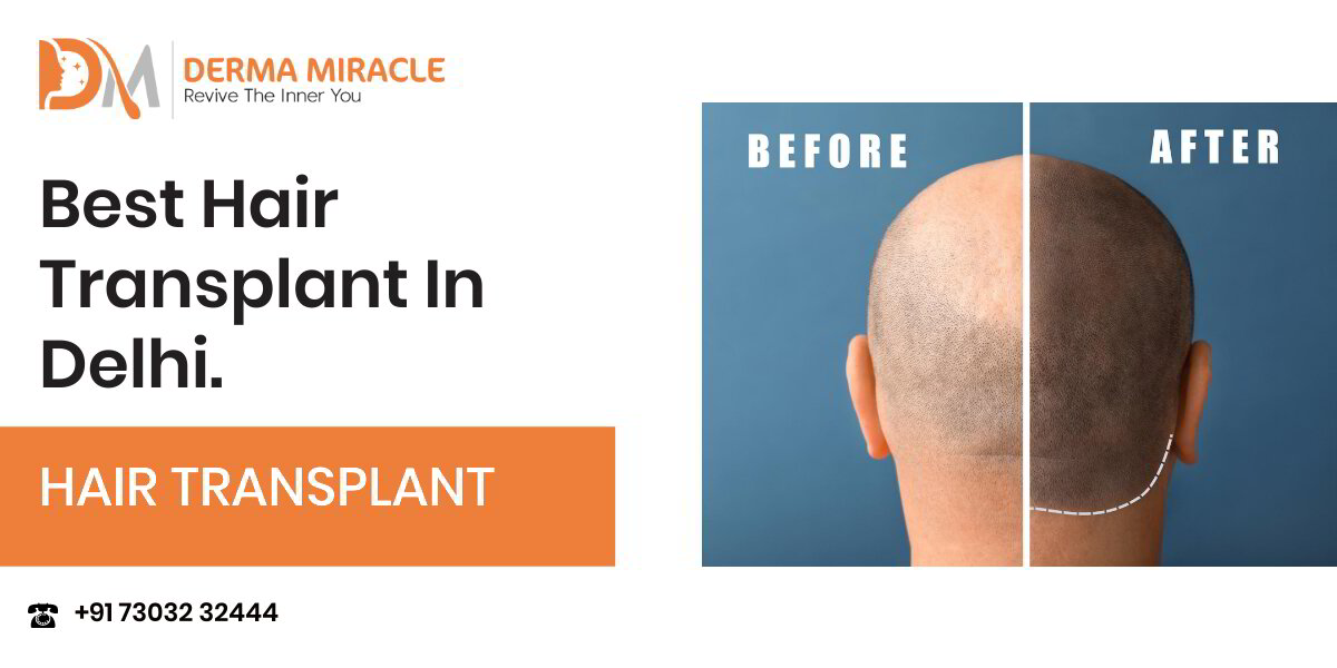 Stream Hair Transplant Clinic in Delhi by DMC Trichology  Listen online  for free on SoundCloud