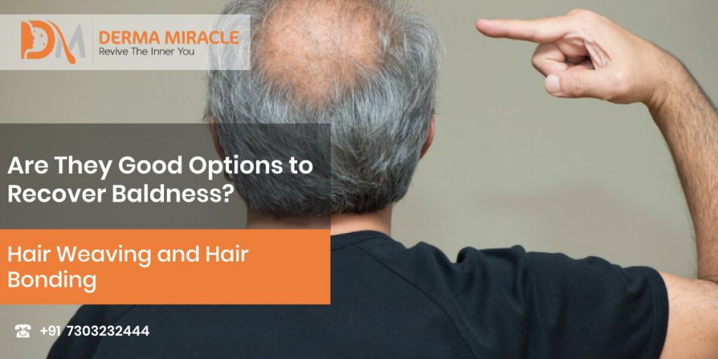 Hair Weaving and Hair Bonding – Are They Good Options to Recover Baldness?  – Derma Miracle