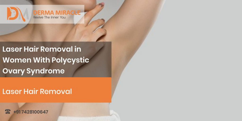 Laser Hair Removal in Women With Polycystic Ovary Syndrome (PCOS) – Derma  Miracle