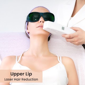 Upper Lip Laser Hair Removal